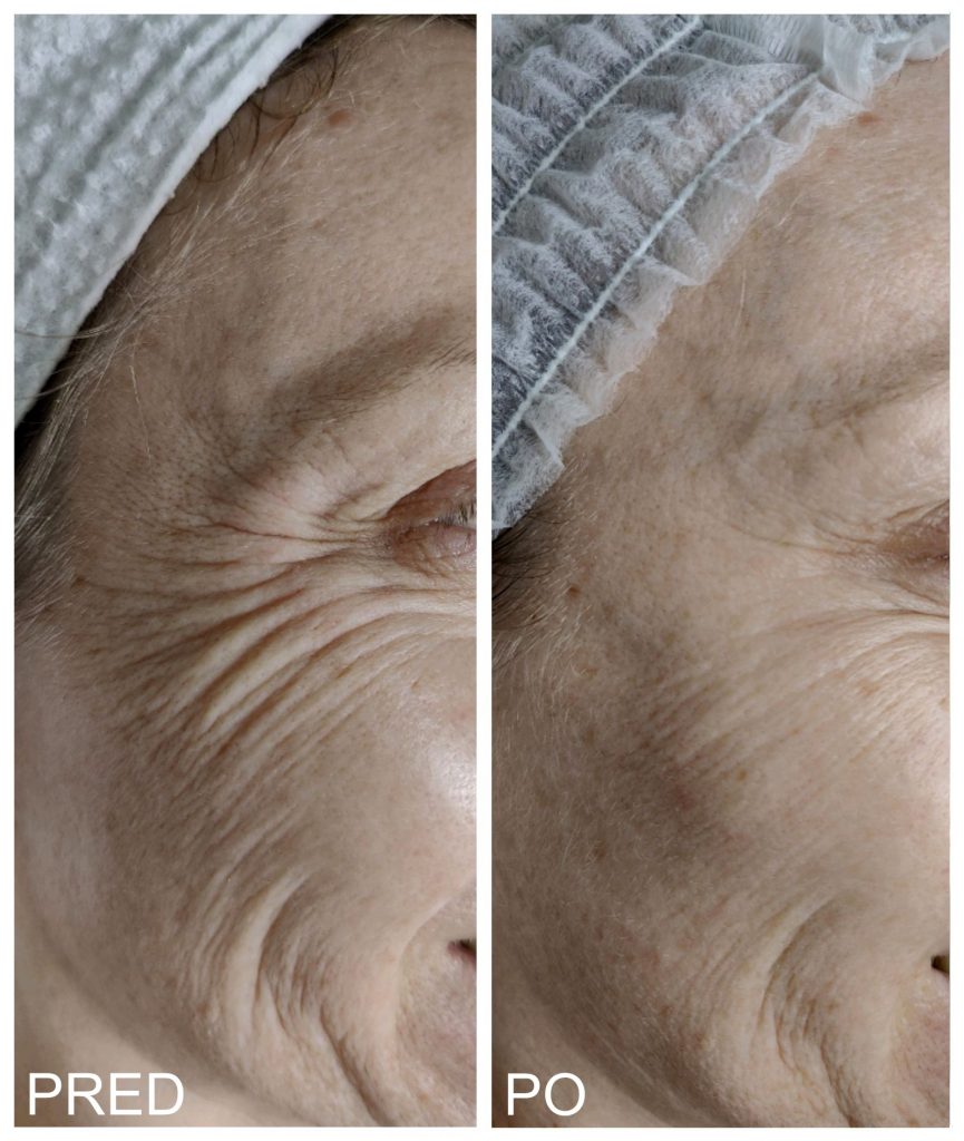 osetrenie_botox_porovnanie_pred_po